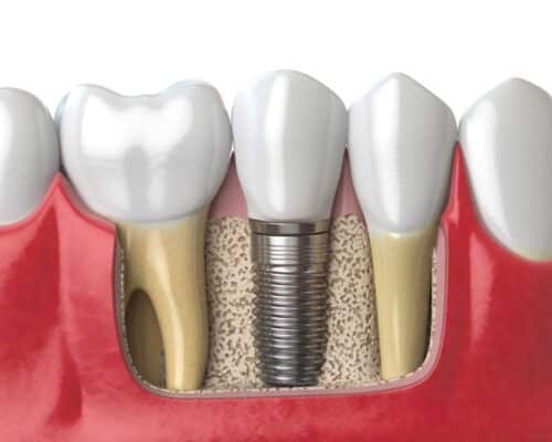 Implantologia Dentale a Bari: Il Ripristino dei Denti Mancanti