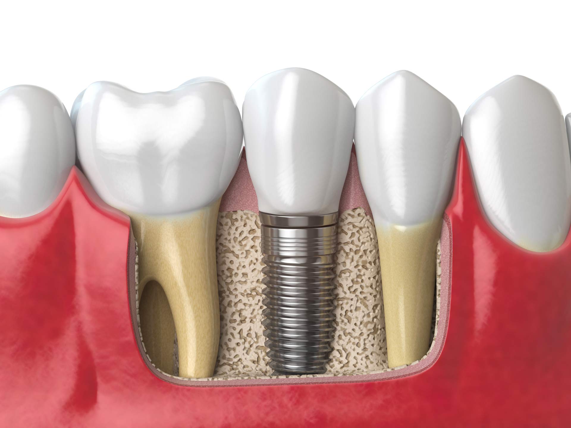 Implantologia Dentale a Bari: Il Ripristino dei Denti Mancanti