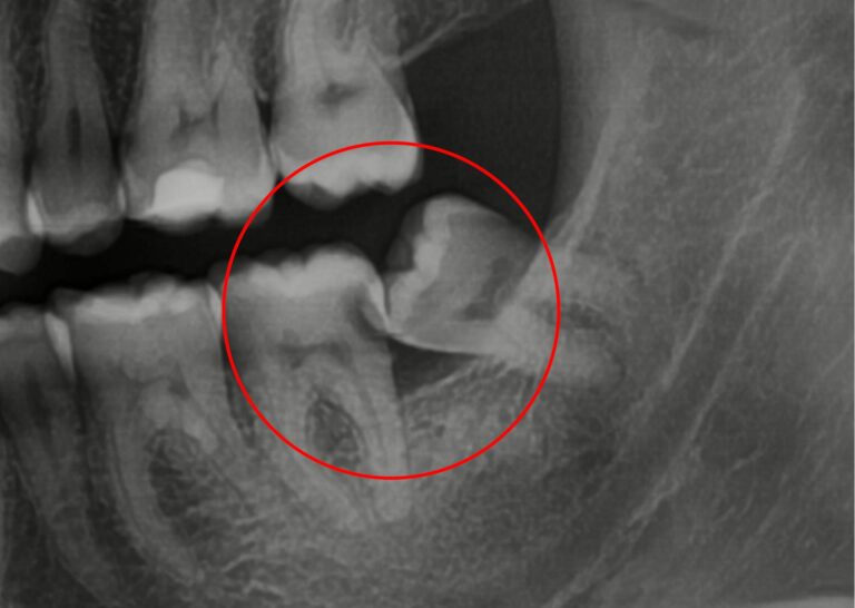 radiografia dente del giudizio bari