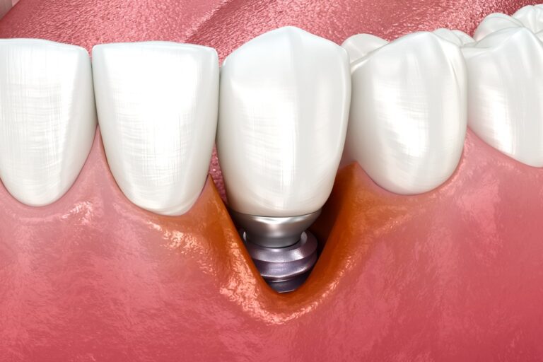 Perimplantite Bari - Studio Dentistico Marinaro Bozzi