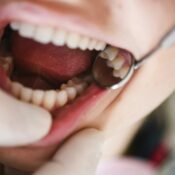 L'Importanza dell'Igiene Periodica dal Dentista - Studio Marinaro Bozzi a Bari