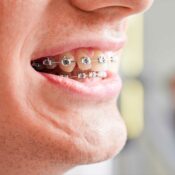 Ortodonzia da Adulti: si può fare?