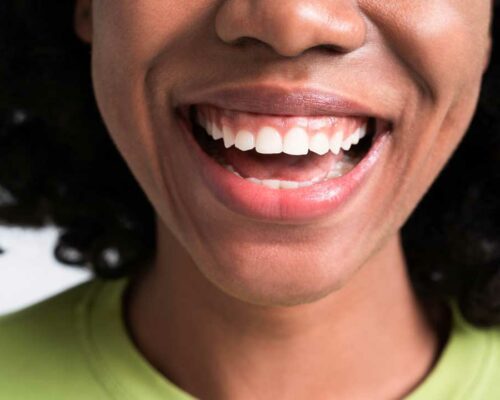 Sorriso gengivale: trattamento del Gummy Smile a Bari