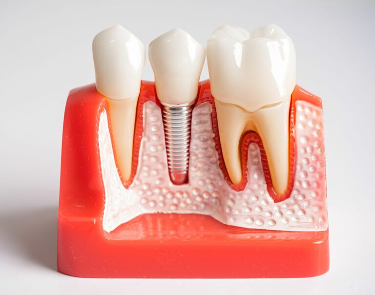 Quanto Dura un Impianto Dentale? Studio Dentistico Marinaro Bozzi a Bari